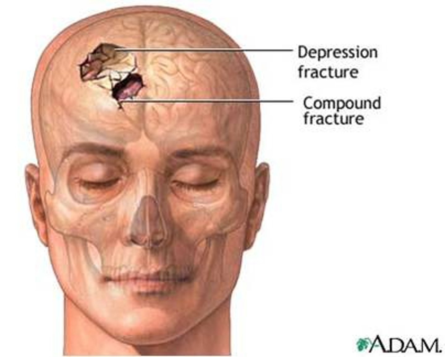 <p>Depressed skull fracture</p>