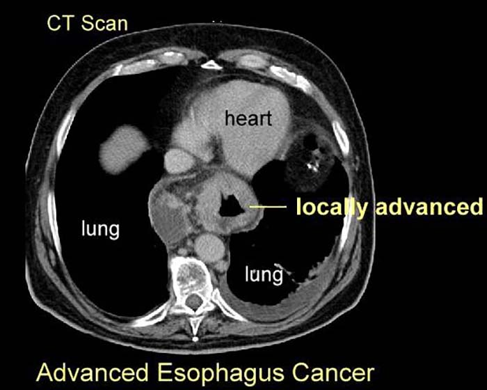 <p>What are the best imaging studies for esophageal carcinoma?</p>