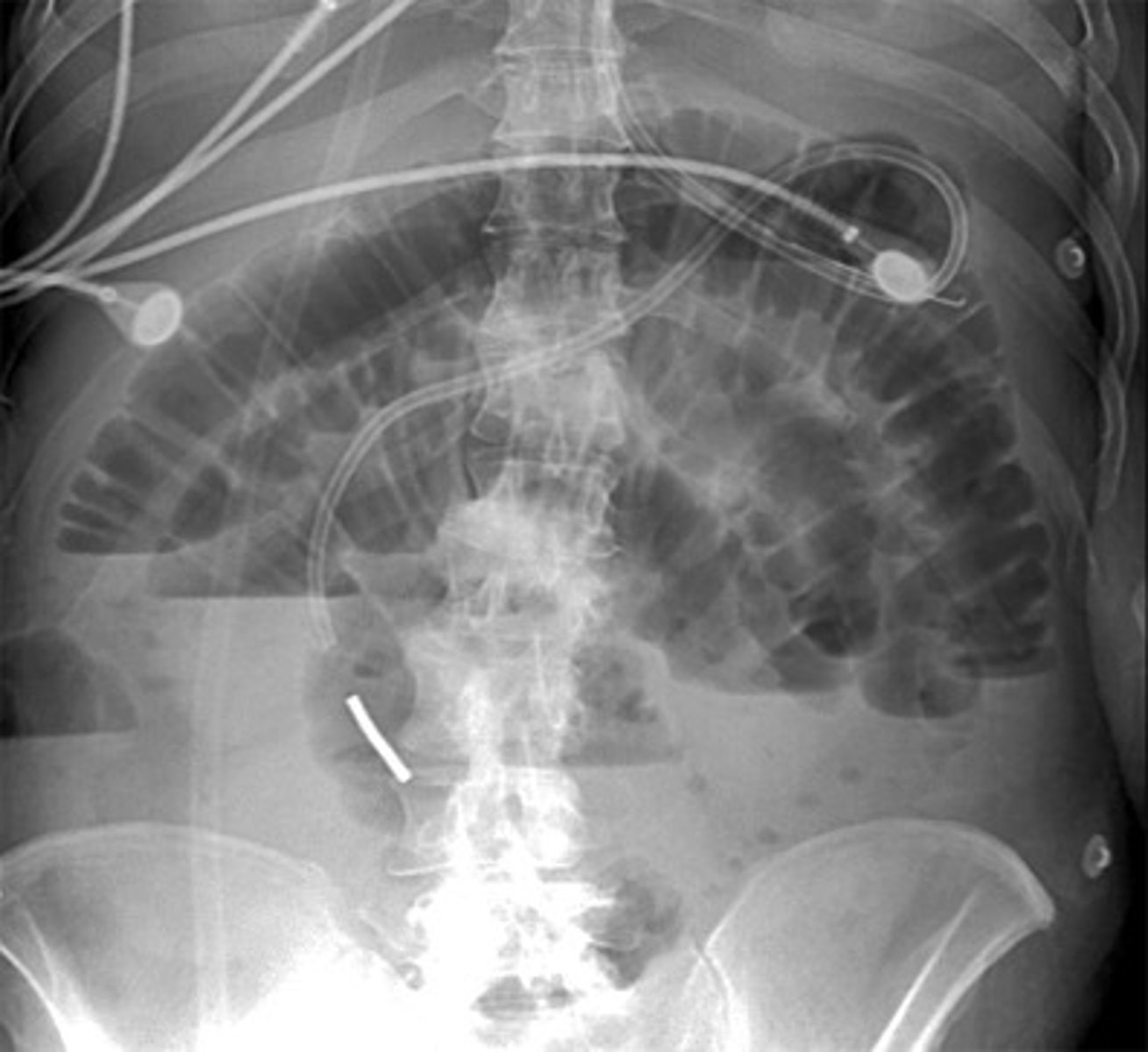 <p>1.) Abdominal Series x-ray: Supine/upright abdomen, upright chest</p><p>- CT oral contrast</p><p>2.) Free air, pneumatosis intestinalis, proximal bowel distention, distal bowel collapse</p><p>3.) Small Bowel Obstruction</p><p>4.) Surgery</p>