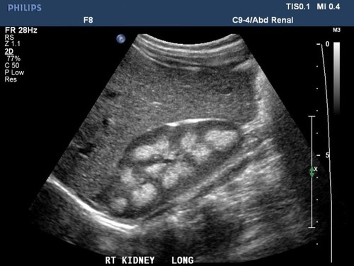 <p>A condition of calcium deposits within the renal parenchyma</p>