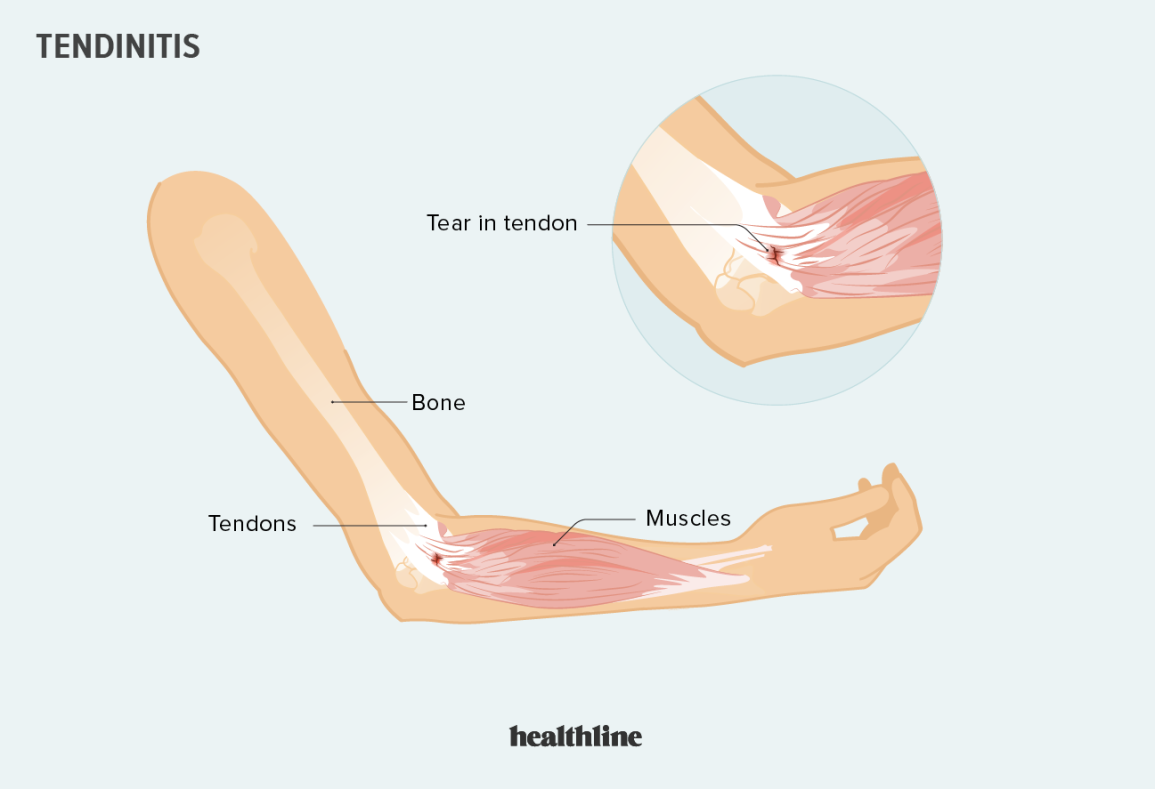 <p>overuse of the tendon</p><ul><li><p>weak point is where the muscle and tendon connect (common area for tendonitis)</p></li></ul><p></p>