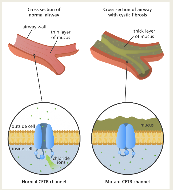 <ul><li><p>Inherited disease of the secretory glands</p></li><li><p>DNA mutations that alter the conformation of a Cl- channel</p></li></ul><ul><li><p>Pulmonary obstruction due to thickened mucus in the small airways causing recurrent bacterial infections</p></li><li><p>Over 800 mutations detected </p></li></ul><ul><li><p>70% of patients share mutation at aa508</p></li></ul><p></p>