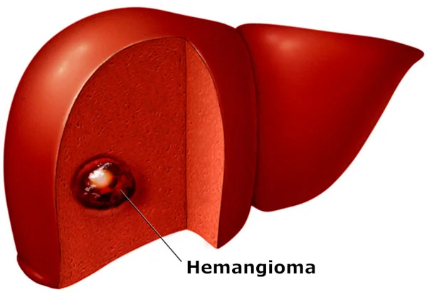 <p>Hemangioma</p>