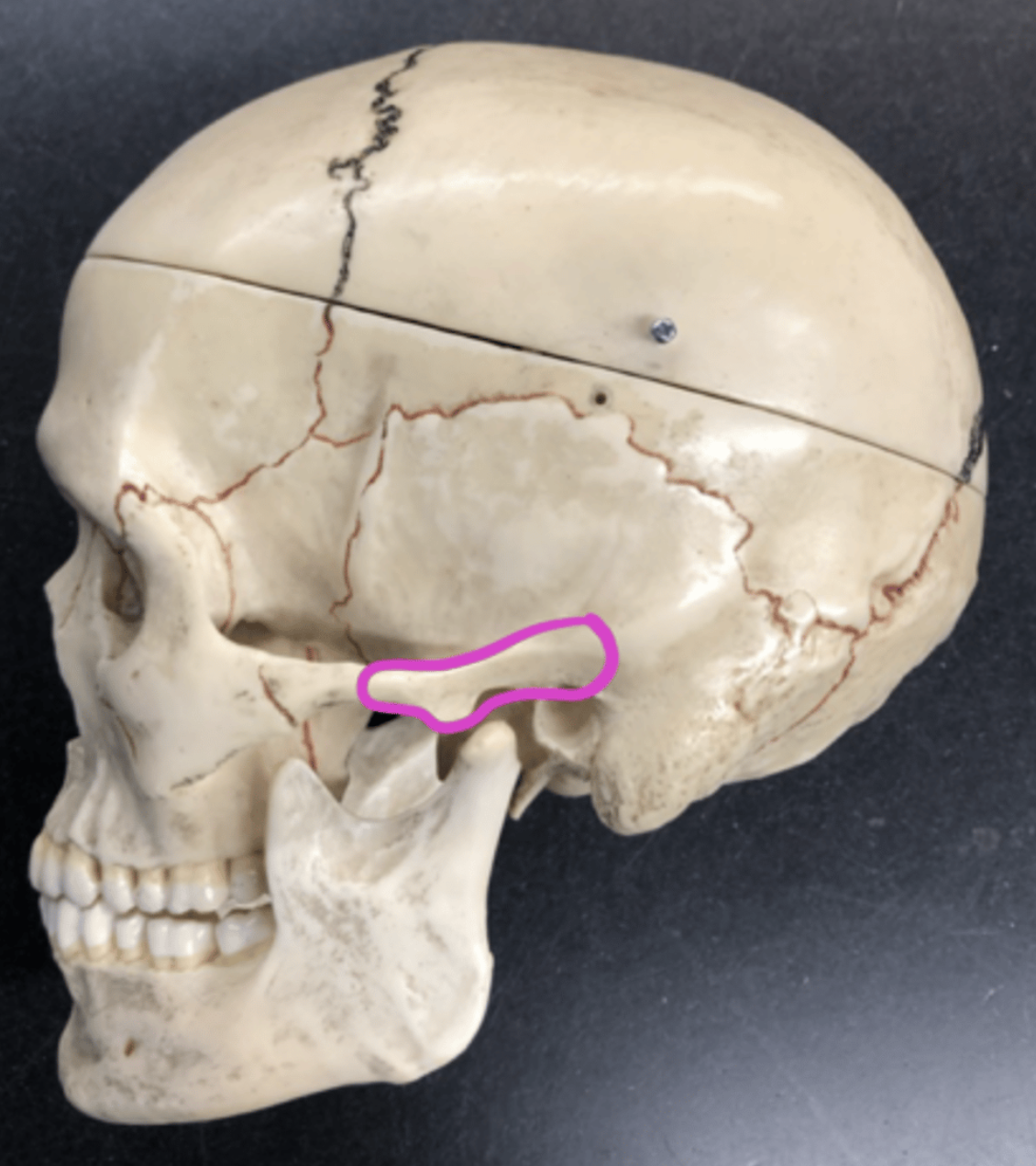 <p>zygomatic process of the temporal bone</p>