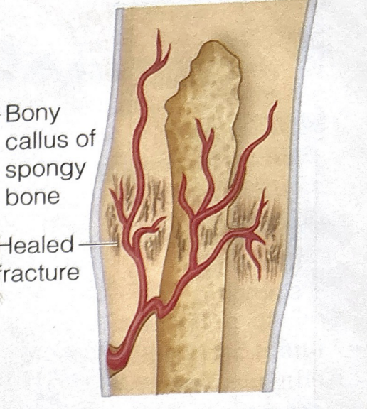 <p>fourth stage of bone fracture healing</p>