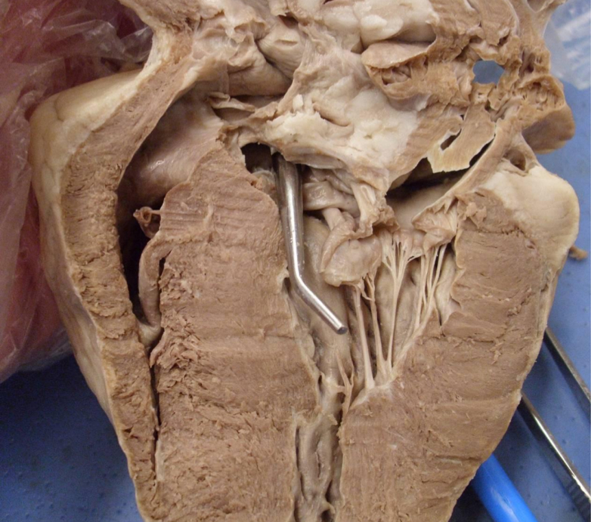 <p>What valve is the probe passing through</p>