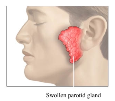 <ol><li><p>blockage of the durect</p></li><li><p>acute viral or bacterial infections</p></li><li><p>autoimmune diseases</p></li><li><p>neoplastic disease (tumors)</p></li></ol><p></p>