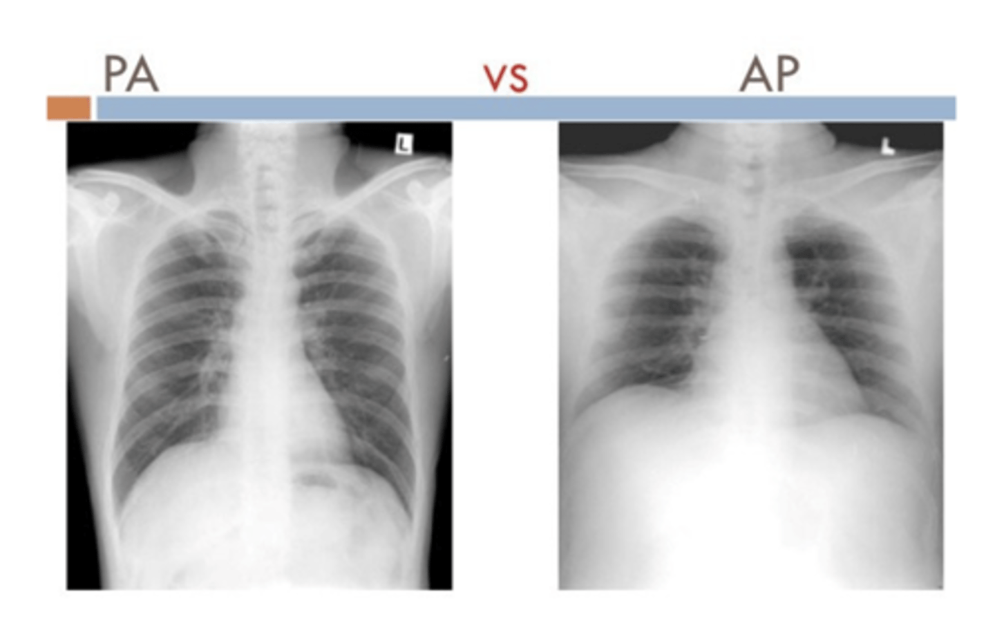<p>PA</p><p>⚬Scapula in periphery</p><p>⚬Clavicles project over lung fields</p><p>⚬Posterior ribs are distinct</p><p>AP</p><p>⚬Scapula are over the lung field</p><p>⚬Clavicles above apex of lung</p><p>⚬Anterior ribs are distinct</p>