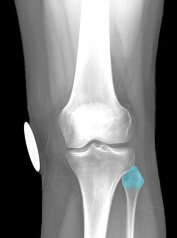Provides attachment for fibular (lateral)
collateral ligament of knee and biceps
femoris muscle