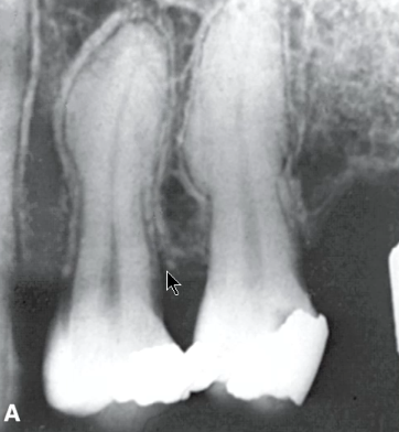 <p>irregular bulbous enlargment of root </p>