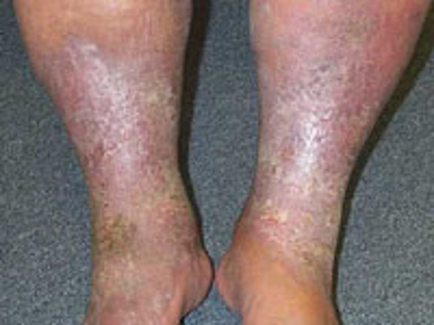 <p>Stasis Dermatitis</p>