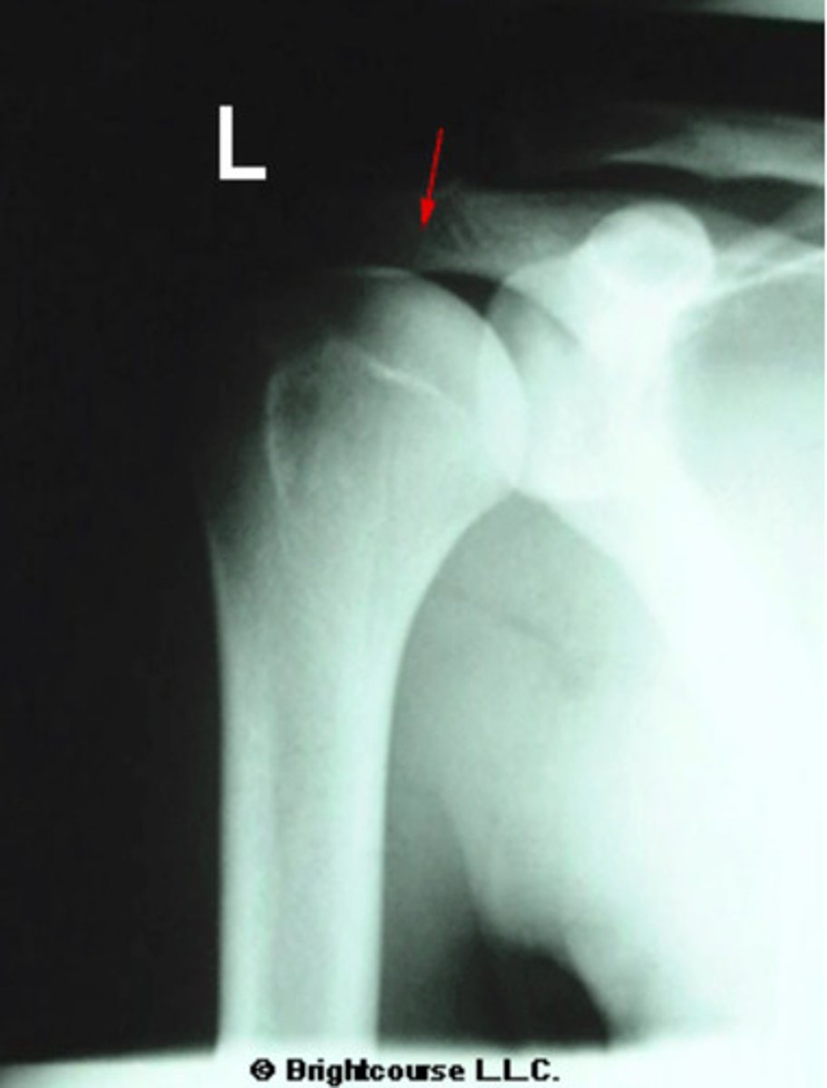 <p>What is being pointed out by the arrow in the image?</p>