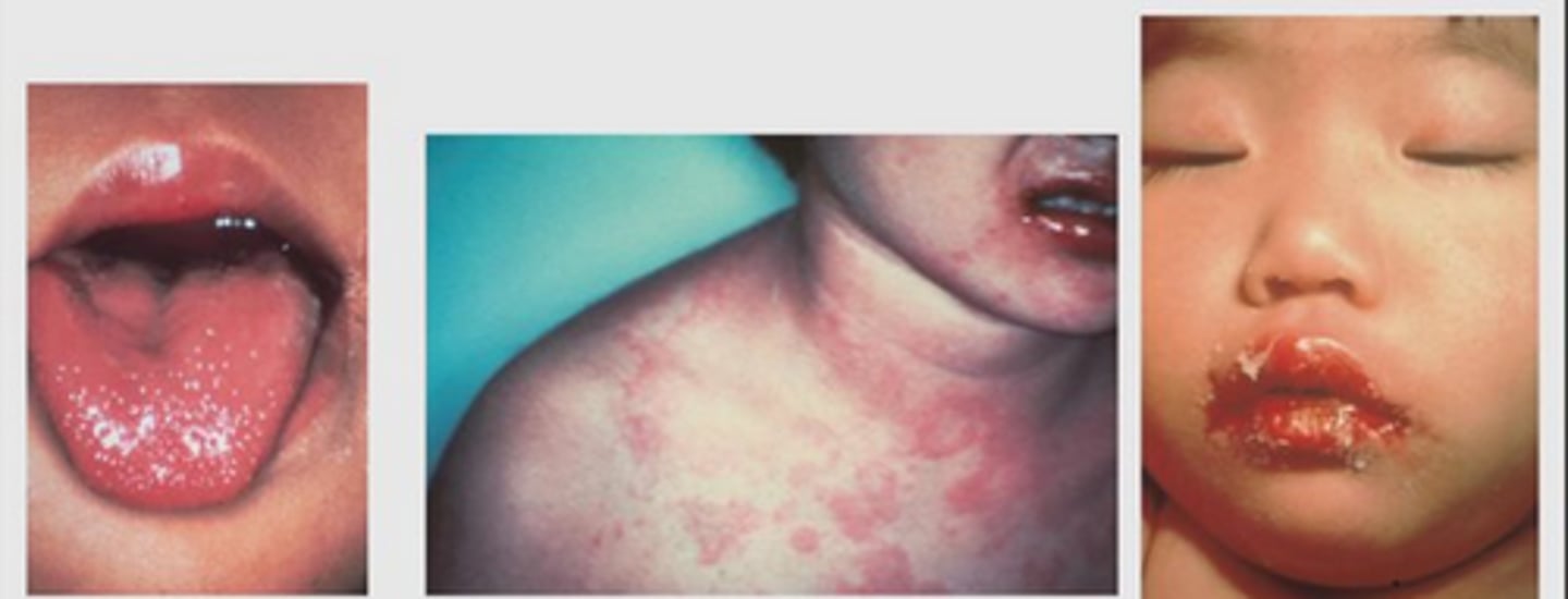 <p>Fever > 5 days</p><p>AND</p><p>4 out of 5 findings:</p><p>- Nonexudative conjunctivitis</p><p>- Extremity changes</p><p>- Cervical lymphadenopathy</p><p>- Oral mucosa changes</p><p>- Polymorphous rash</p>