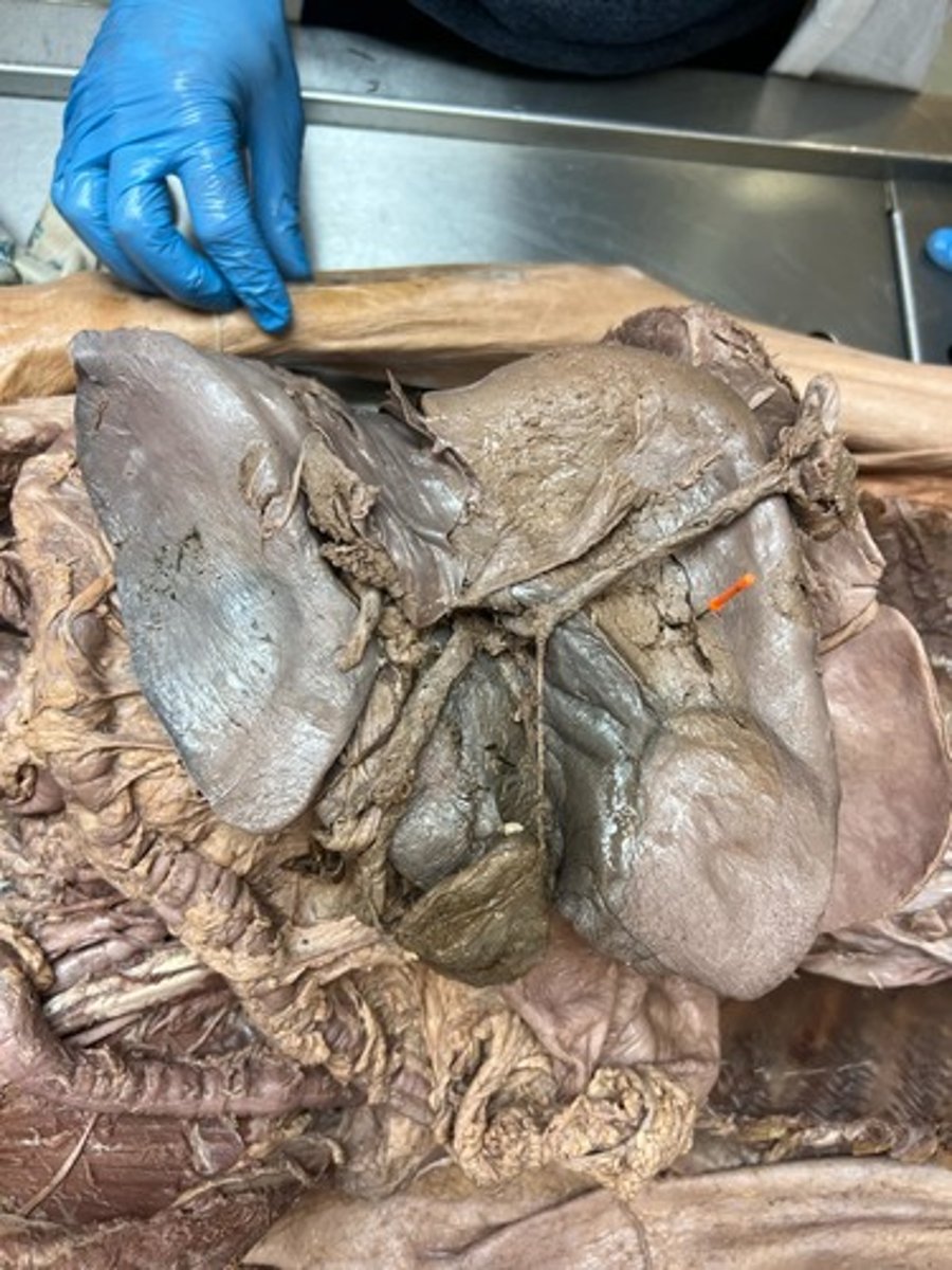 <p>right lobe of liver</p>