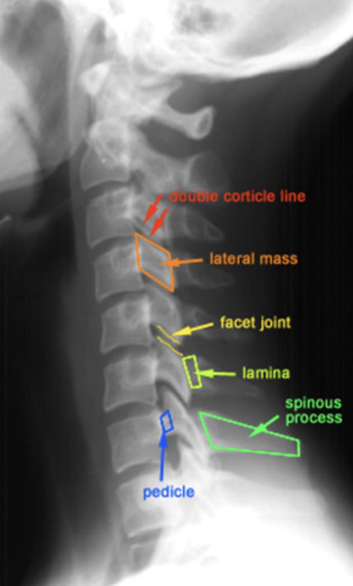 <p>double cortical line</p><p>lateral mass</p><p>facet joint</p><p>lamina</p><p>pedicle</p><p>spinous process</p>