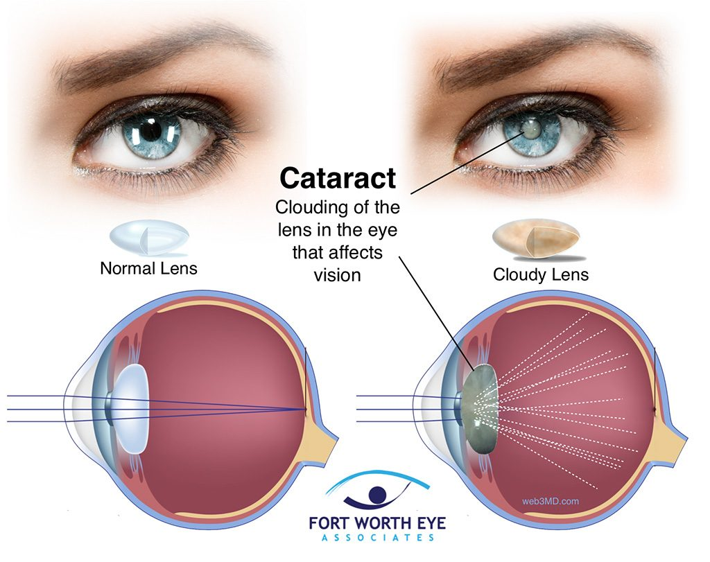 <p>PP: aging→denaturation of lens protein→opacity of the lens</p><p>E: age<br>UV light<br>trauma<br>steroids<br>diabetes<br>cigarette smoking<br>family hx</p><p>CM: generalized bilateral blurred vision</p><p>PE: cloudy lens</p><p>TX: surgical removal+implant</p>