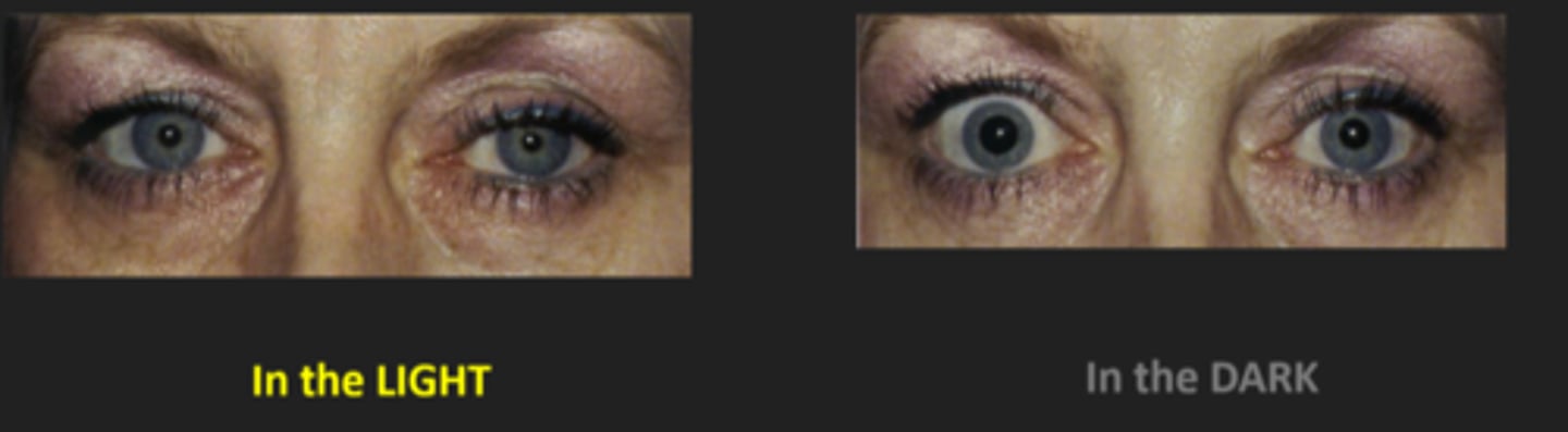 <p>response to light and near are both intact</p><p>anisocoria is greater in dim illumination bc pupil cannot dilate = remains small</p>