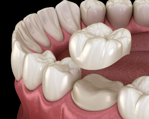 <p>used when there is limited tooth structure left due to a caries lesion that cannot be restored with an onlay or when an existing crown needs to be replaced</p>