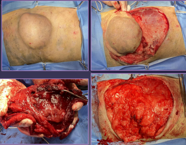 <p>Surgical technique - oncology</p>