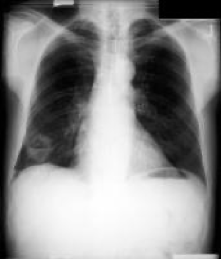<p>What type of lung cancer is this?</p>