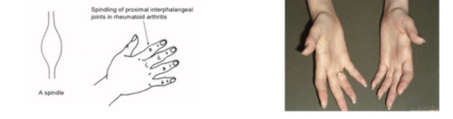 <p>Symptoms:</p><p>Early morning stiffness</p><p>Worse with rest, better with movement</p><p>Signs:</p><p>Soft tissue swelling eg loss of valleys between Knuckles</p><p>(Raised ESR,CRP)</p>