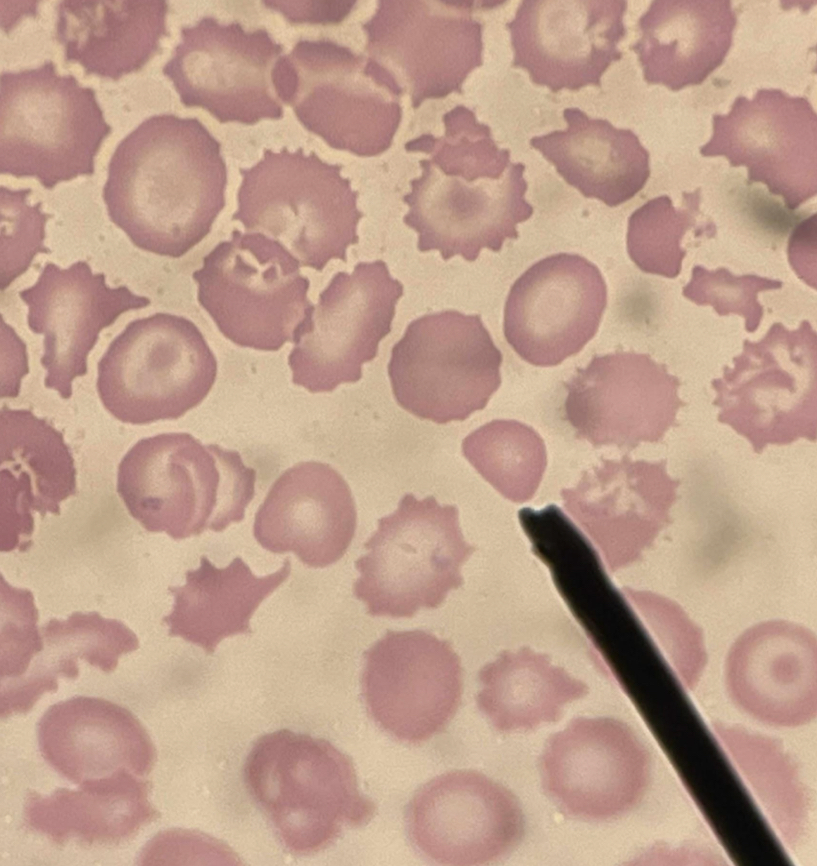 <p>A. Identify the pointed cell</p><p>B. Describe the striking feature</p><p>C. Associated with what pathological findings?</p><p>D. What are the other categories under this cell?</p>