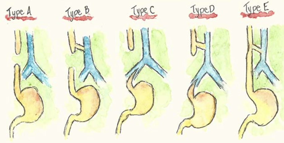 <p>what are the five different types of atresia with and w/o TEF?</p><p></p>