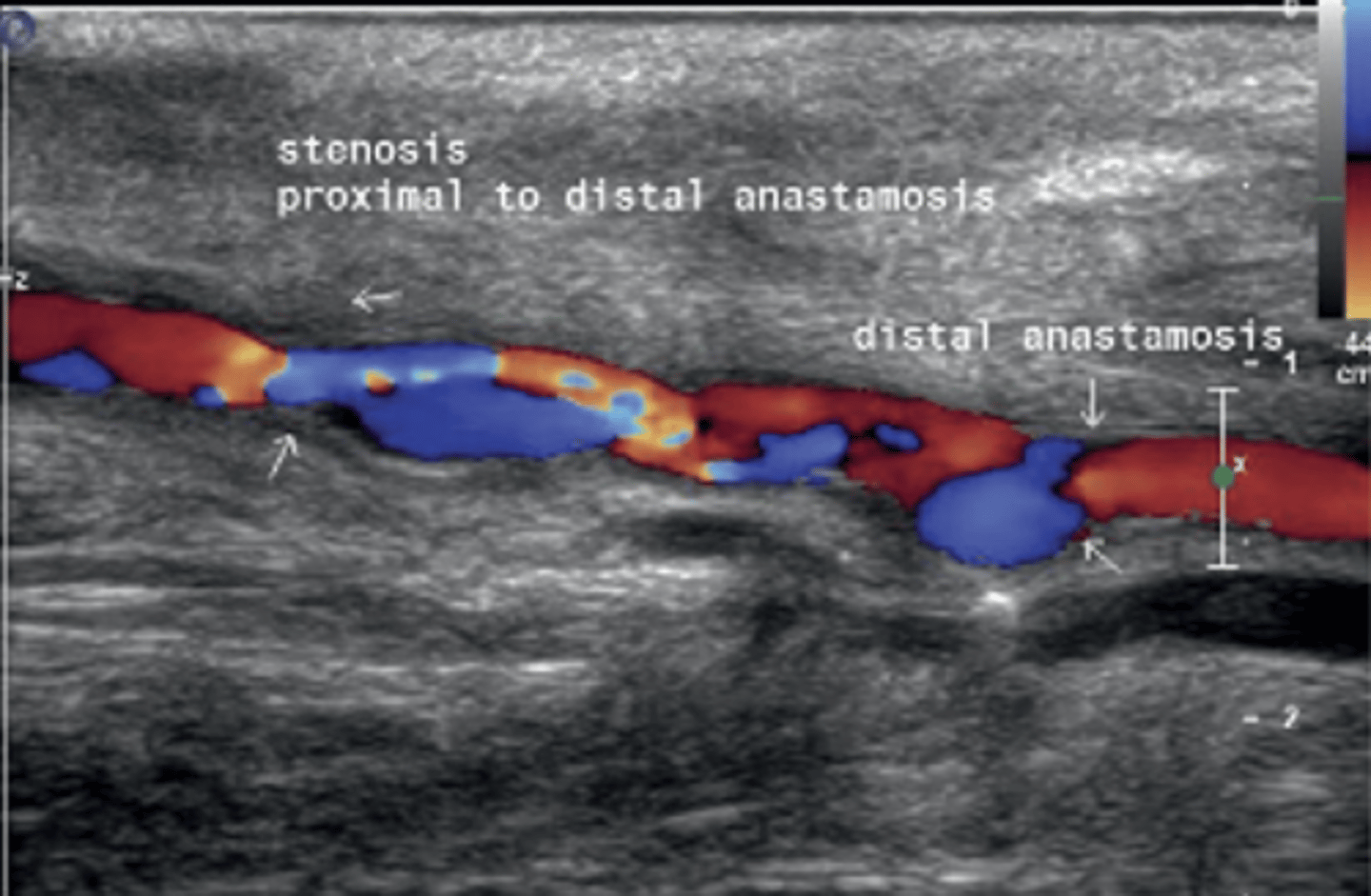 <p>Overgrowth of cells into the intimal layer</p><p>Creates narrowing and stenosis</p>