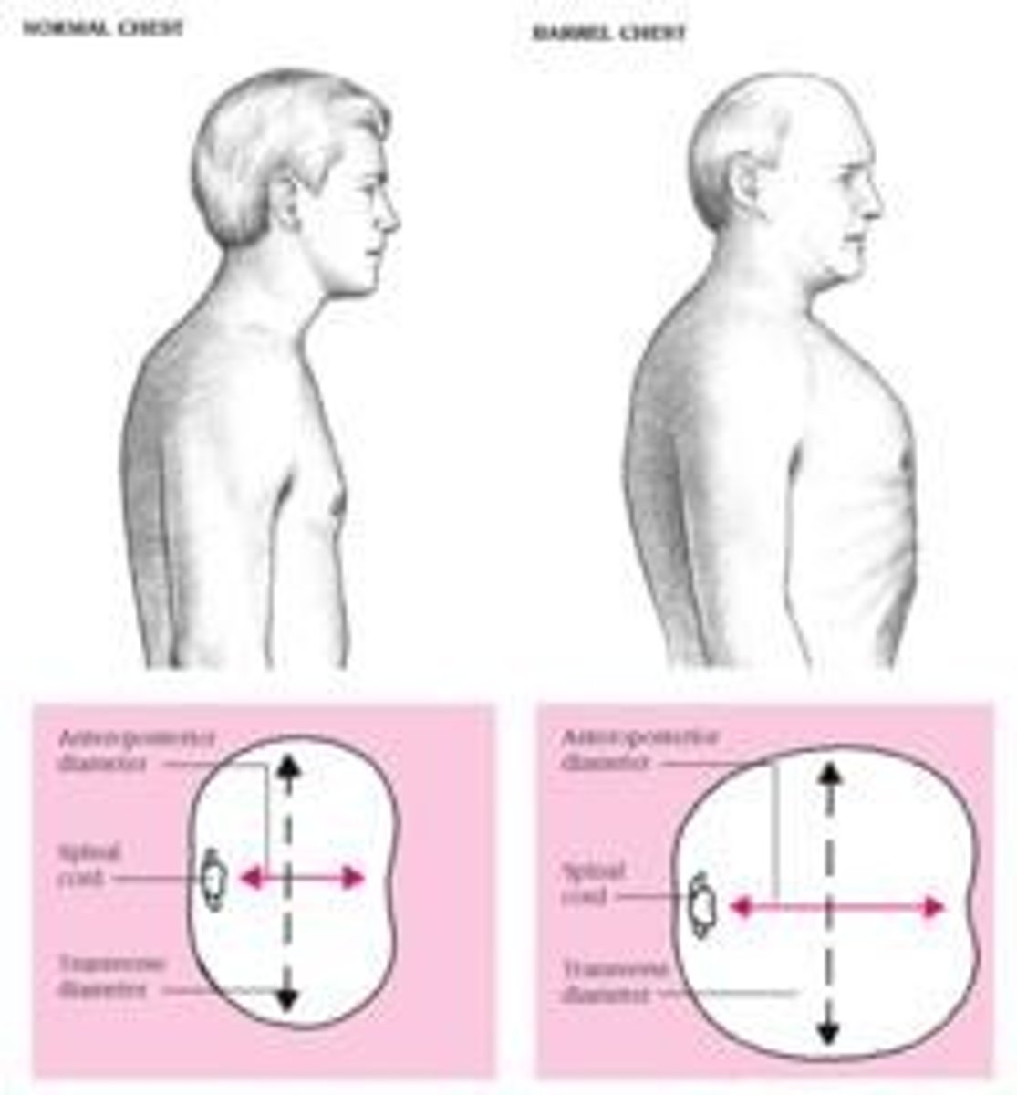 <p>-dyspnea upon exertion (when the person is physically active)</p><p>-think pink puffer!</p><p>-barrel chest</p><p>-increased anterior-posterior</p><p>-thoracic diameter (from 1:2 to 1:1) AKA barrel chest!</p><p>-activity intolerance</p><p>-anorexia</p><p>-malaise</p>
