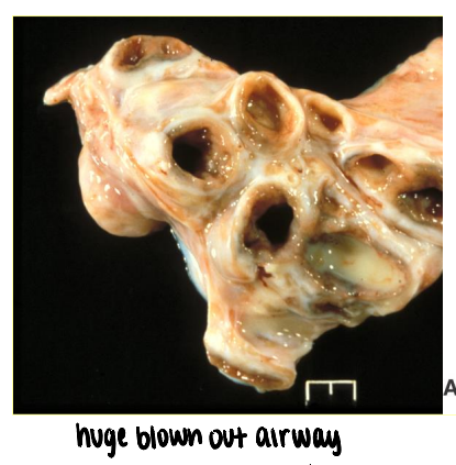 <ul><li><p><strong>dilation of bronchi beyond normal diameter</strong> due to wall destruction</p><ul><li><p><strong>inflammatory cell-mediated damage</strong> to wall</p></li></ul></li><li><p>associated with <strong>chronic bacterial bronchitis</strong></p></li></ul><p></p>