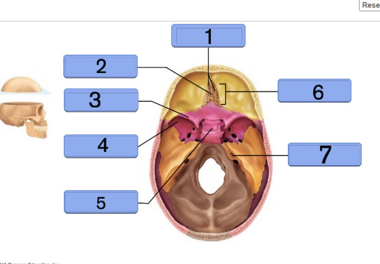 <p>Crista Galli of the Ethmoid Bone</p>