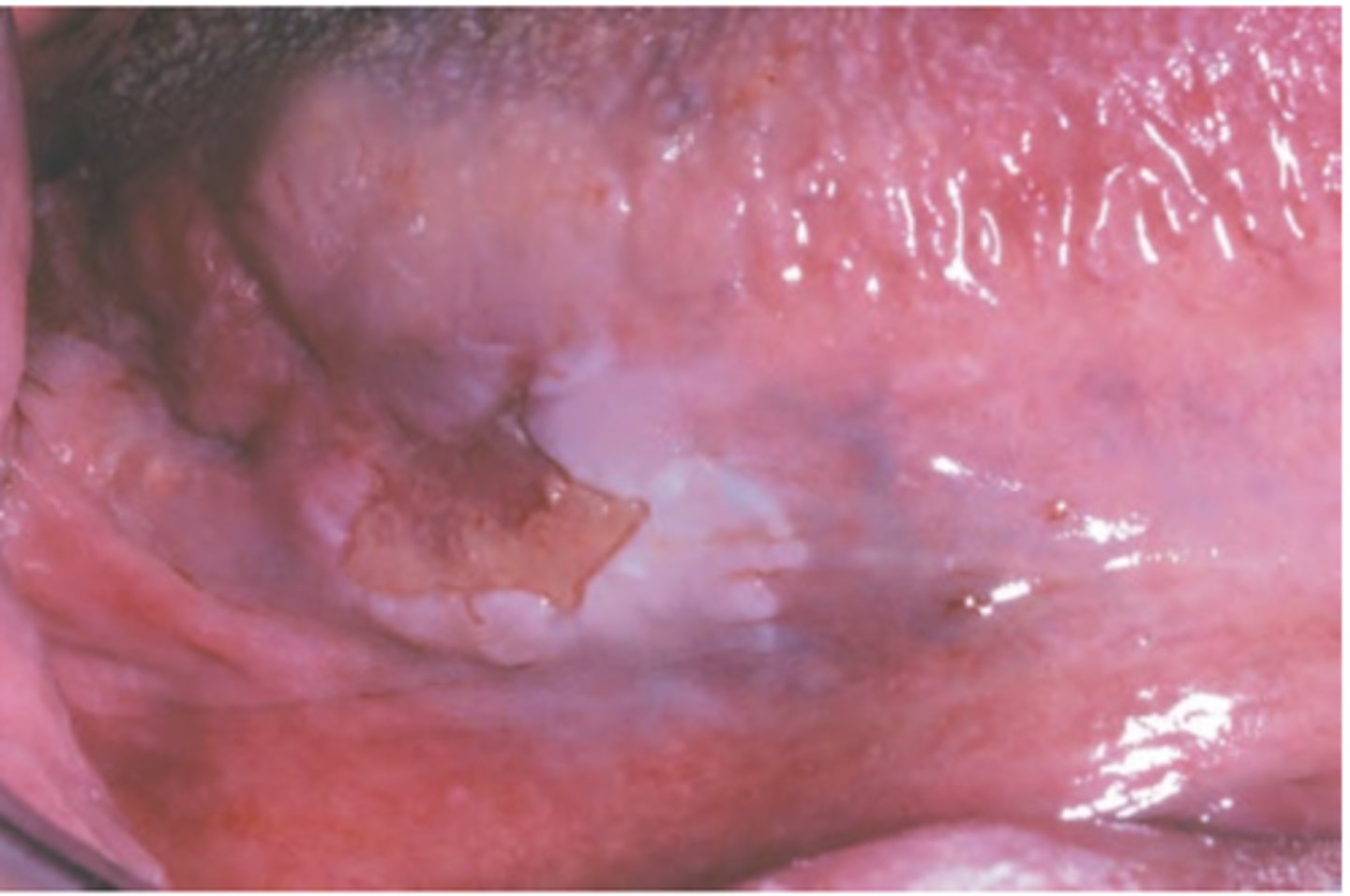 <p>Hint: most common sites of this pathology are tongue (posterior lateral and ventral) and floor of mouth</p>
