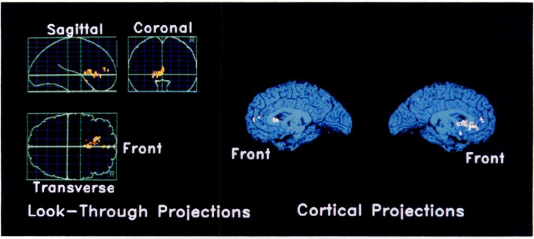 <p>Significantly more activity in mPFC, left lateral PFC, ACC, fornix (memory structure), insula, thalamus, cerebellum, putamen, and caudate. Significantly less activity in visual cortex. </p><p>Pixels indicate areas significantly MORE active for sad compared to neutral. </p>
