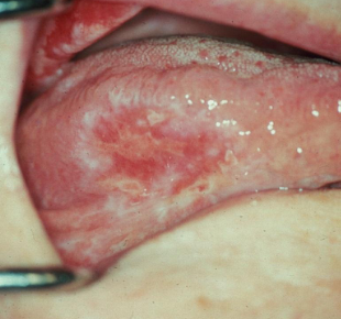 <p>Buccal mucosa, gingiva, tongue, lip</p>