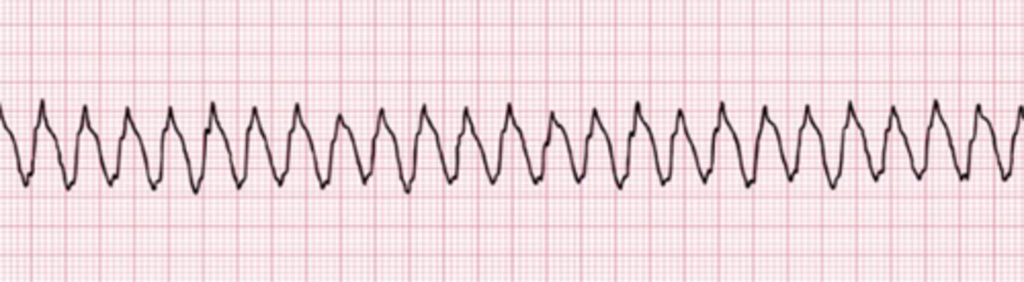 <p>Ventricular tachycardia</p><p>The cardiac monitor reveals ventricular tachycardia. In pulseless ventricular tachycardia, the ventricular rate is usually greater than 180 beats per minute, and the QRS complexes are very wide.</p>
