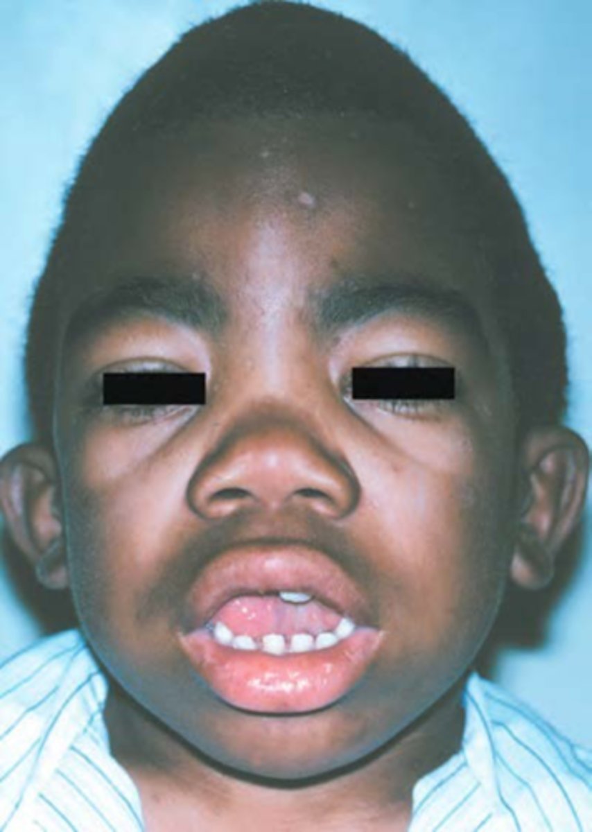 <p>-cloudy degeneration of the cornea may lead to blindness</p><p>-vary depending on specific syndrome</p><p>-some degree of intellectual disability</p><p>-coarse facial features w/ heavy brow ridges</p><p>-skeletal changes including stiff joints</p>