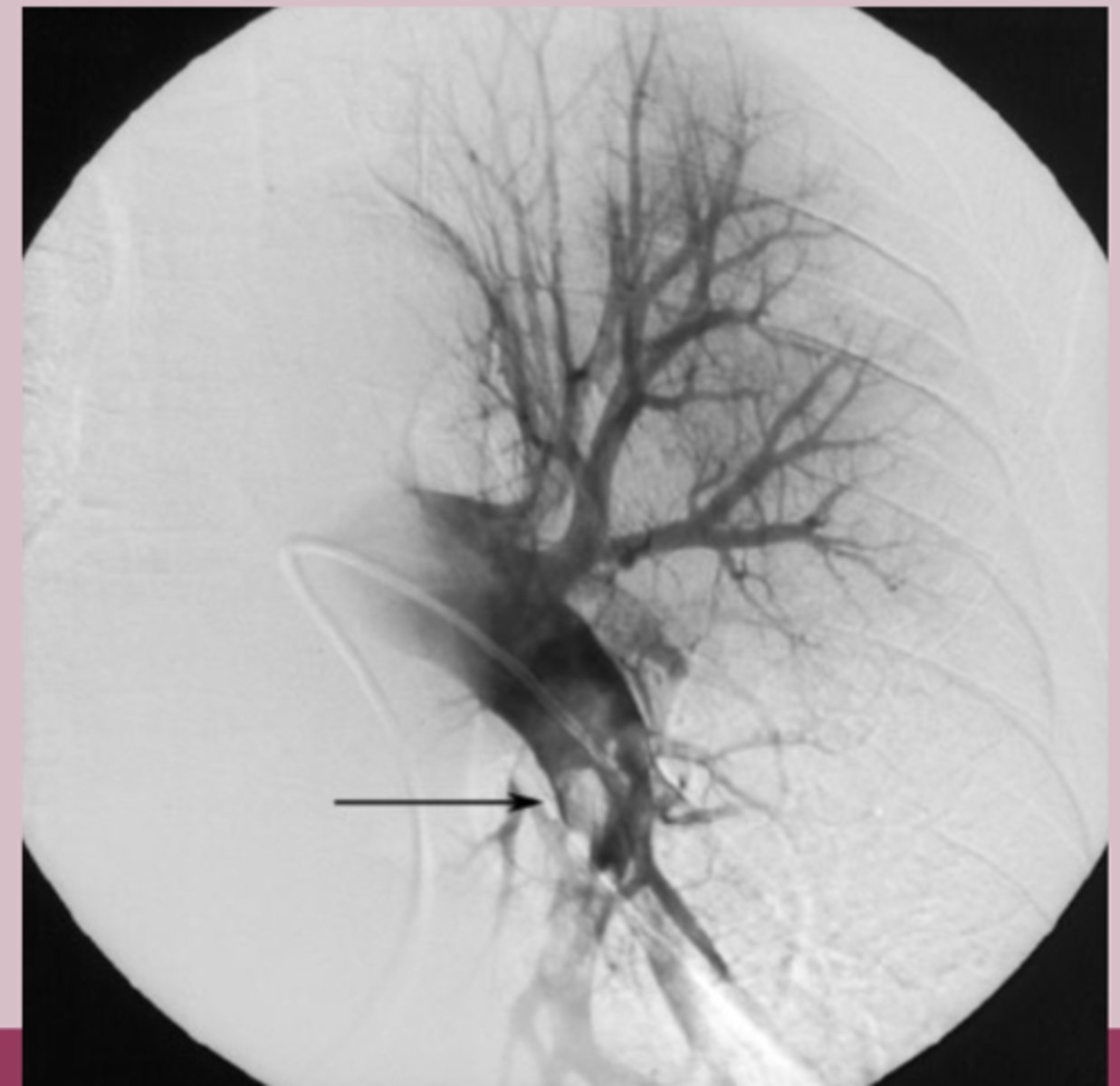 <p>pulmonary angiography: gold standard</p>