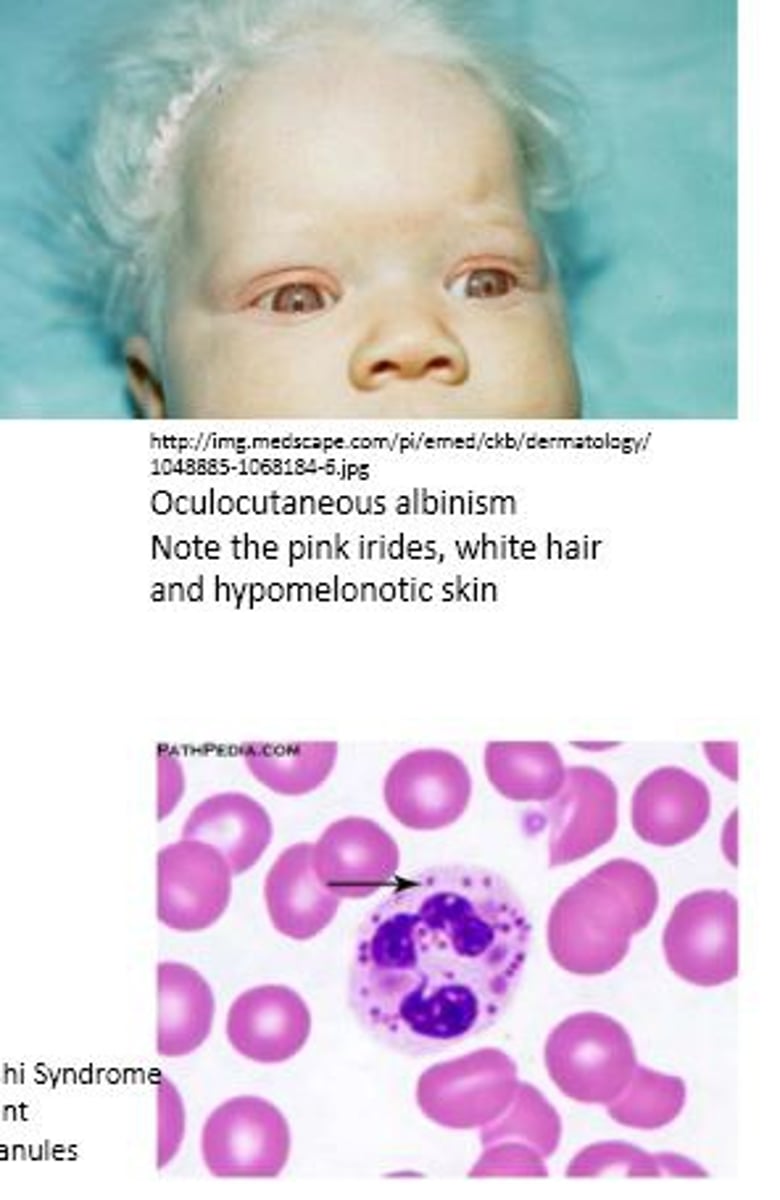 <p>- defect in microtubule polymerization</p><p>- infection prone</p><p>- Giant granules in neutrophils</p><p>- oculocutaneous albinism</p>