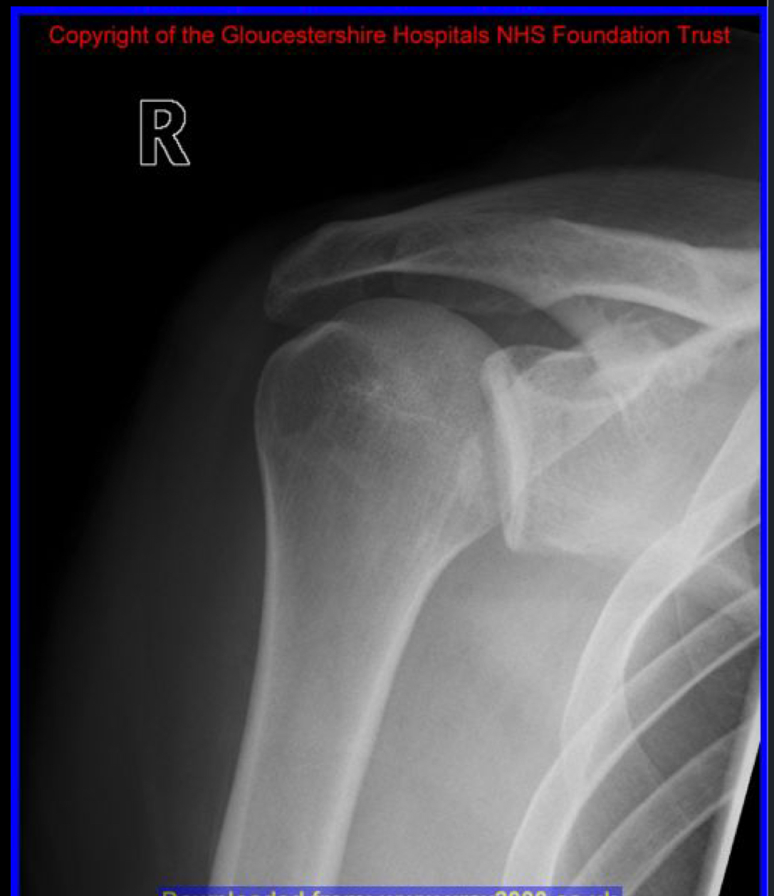 <p>What is the clinical diagnosis of this dislocation?</p>