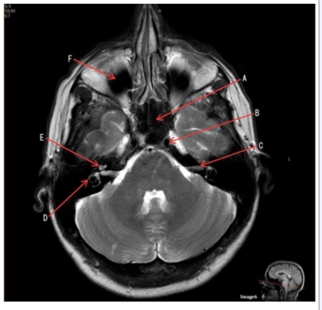 <p><span><strong>Letter B in Image 6 is pointing to:</strong></span></p><p><span>&nbsp;A. Maxillary sinus</span></p><p><span>&nbsp;B. Sphenoid sinus</span></p><p><span>&nbsp;C. Vertebral artery</span></p><p><span>&nbsp;D. Internal carotid artery</span></p>
