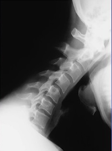 <p>What is this x-ray demonstrating?</p>