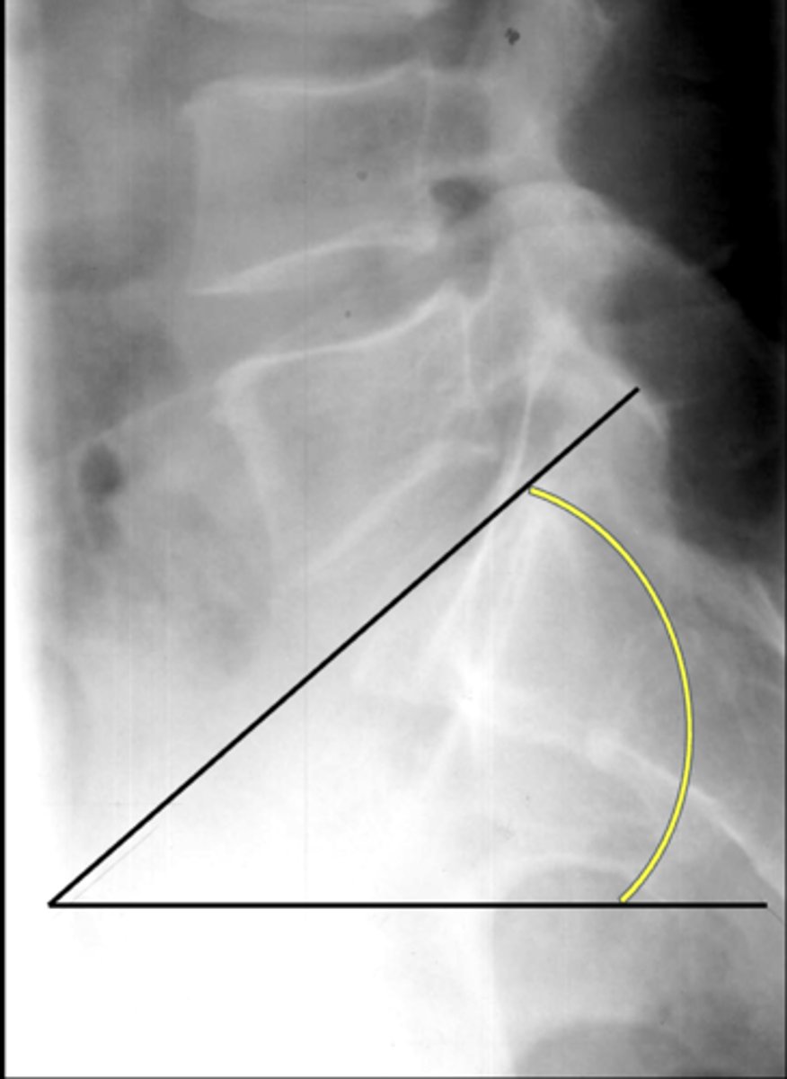 <p>Significance of an increased lumbosacral angle</p>