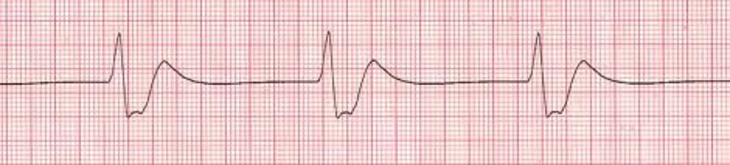 <p>&lt;40</p><p>looks like vtach but slow</p><p>- no P waves (from vent foci)</p><p>- Wide QRS</p><p>(serious, death like rhythm)</p><p>- called "dying heart" rhythm...occasional ventric beat b4 death (asystole)</p>