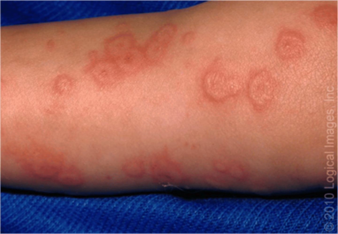<p>reaction of blood vessels in the epidermis and mucous membranes</p><p>-drug reaction, infection, idiopathic</p><p>-"target lesions" palms, soles, mucous membranes</p><p>-resolve in 2-4 weeks</p>