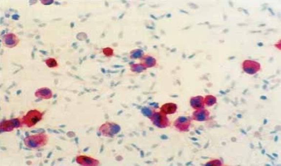 <p>LEUKOCYTE IN SEMEN; CD45- BEARING CELLS ARE STAINED RED </p>