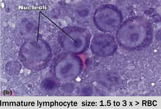 <ul><li><p>Majority ( &gt; 50%) of lymphocytes are immature (lymphocytes are intermediate or large)</p></li><li><p>Easier if lymphocytes contain prominent nucleoli</p><p>(finely granular to dispersed chromatin)</p></li><li><p>Small cell lymphoma difficult to DX</p></li></ul><p></p>