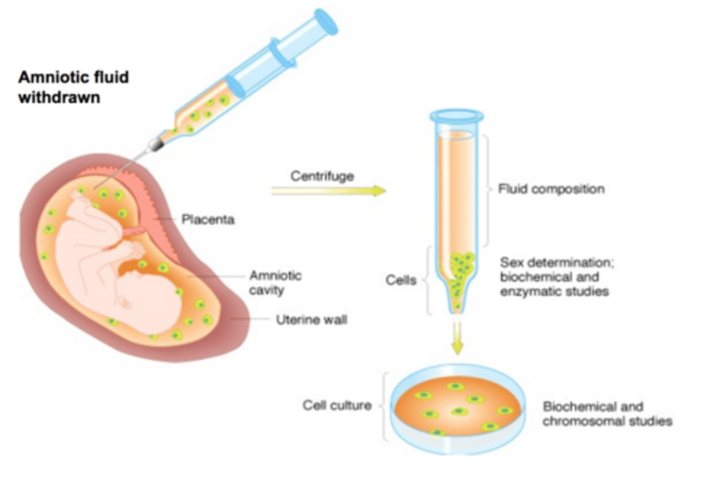 <p>A technique of prenatal diagnosis in which amniotic fluid, obtained by aspiration from a needle inserted into the uterus, is analyzed to detect certain genetic and congenital defects in the fetus</p>