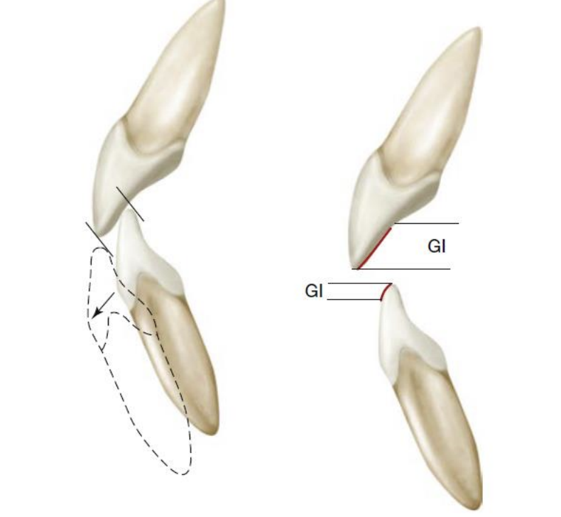 <p>Guiding inclines of anterior mand and maxillary teeth </p>