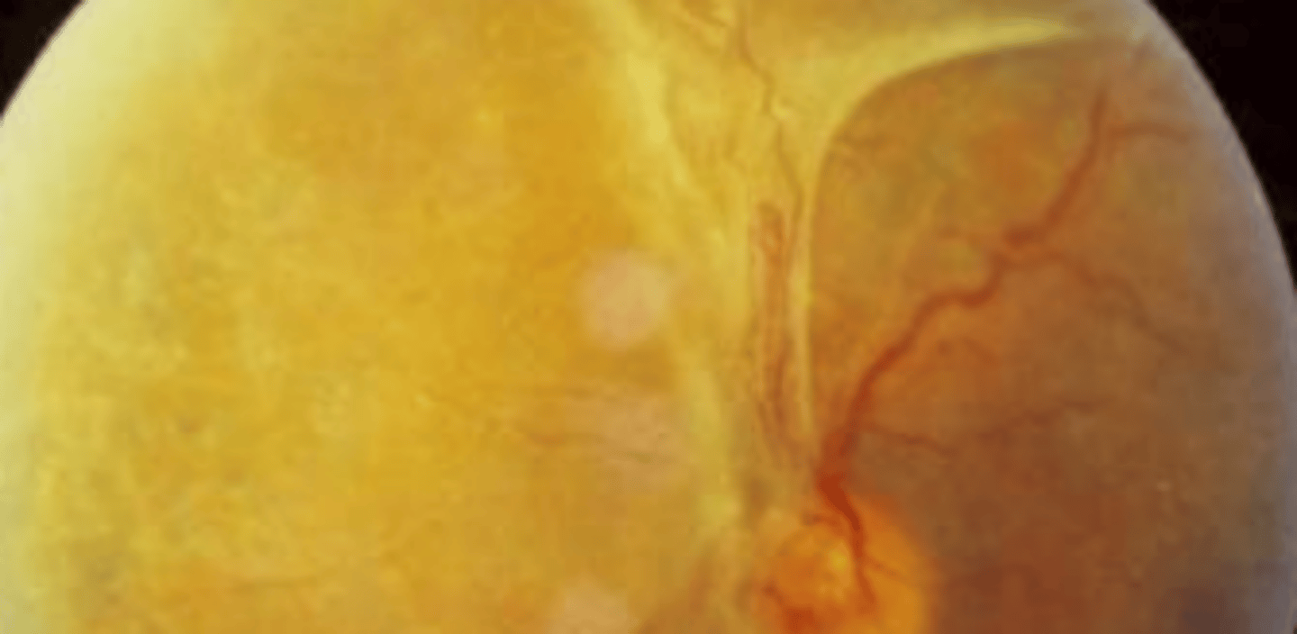 <p>retinal detachment that involves some form of vitreous membrane exerting traction on the retina. Patient may be asymptomatic. A mild APD may be present if a large amount of the retina is involved. Is very common in conditions causing neovascularization**</p>