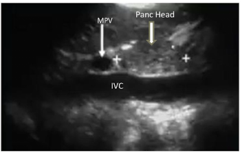 <p>Red = MPV</p><p>Blue = pancreatic Head</p><p>Black = IVC</p>